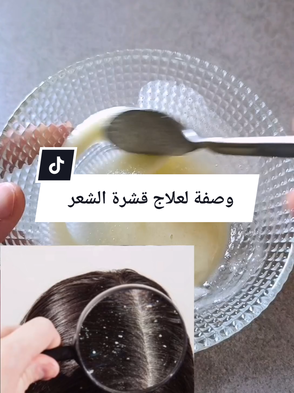 #علاج قشرة الشعر#الشعر-قشرة#الراس-وصفة#طبيعية-شامبو#france🇫🇷 #blanchimentdentaire #france🇫🇷 #الشعب_الصيني_ماله_حل😂😂 