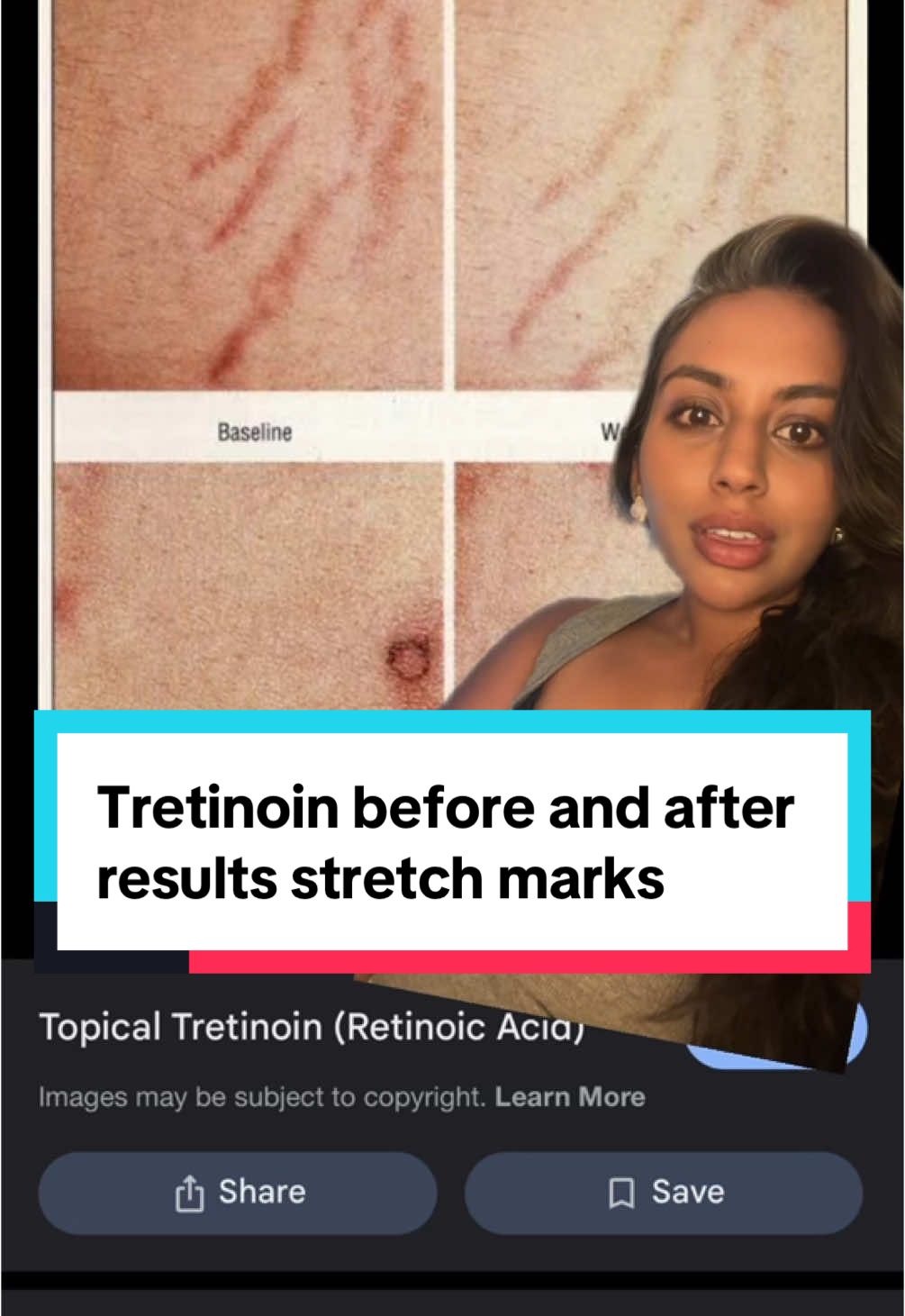Tretinoin before and after results stretch marks. A review of some evidence and tips around use for reducing the appearance of stretch marks. #stretchmarks #tretinoin #skincare #creatorsearchinsights 