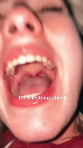 Tonsil check #tonsils #tonsillectomy #tonsilstones #badbreath #health #surgery 
