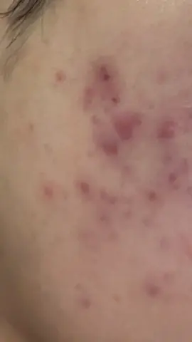 아니ㅋㅋㅋㅋ설에 할아버지 댁 갔다가 집으로 돌아왔는데 거기 수돗물이 안 좋았는지 모르겠는데 거기서 세수한 뒤로 왕건이 여드름들이 볼, 이마, 턱에 났어요.. 아니ㅋㅋㅋ 이마에 난거 진짜 열받네 어카지.. #지성 #여드름 #스킨케어 #화농성 #좁쌀 #흔적 #망함 #도와주세요 