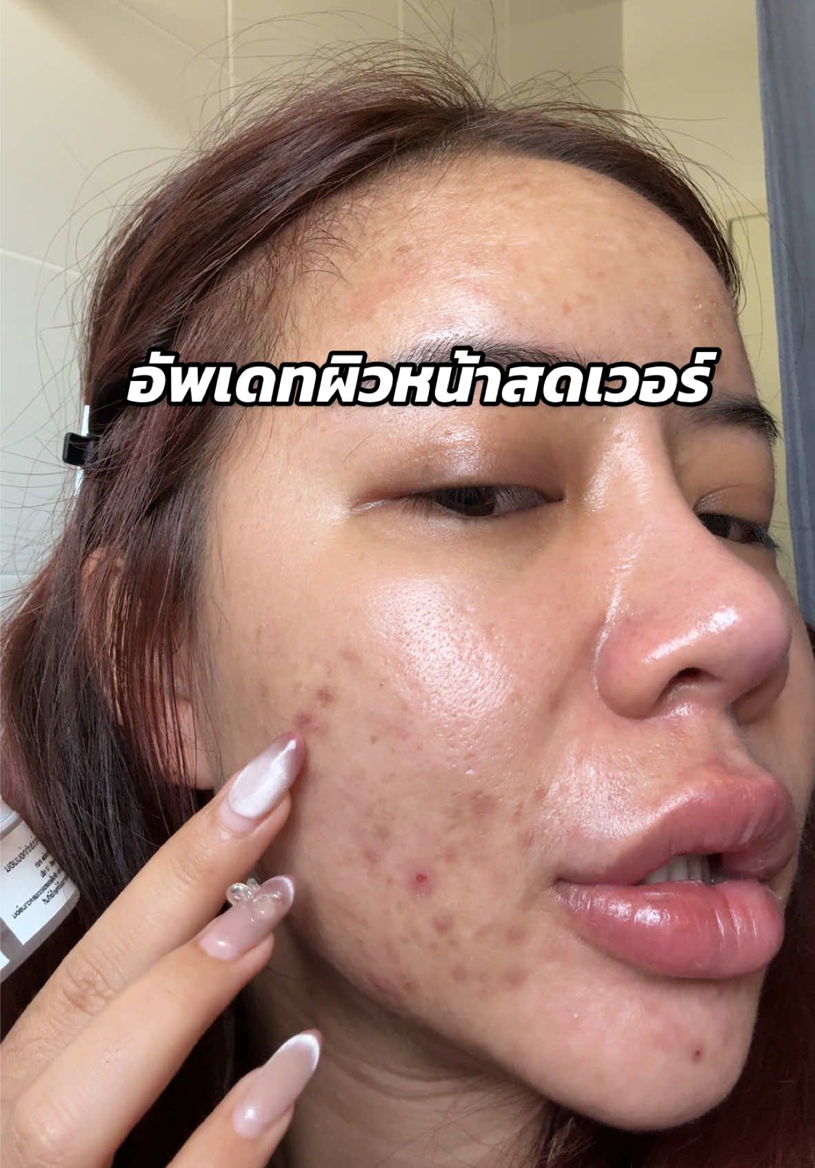 พิกัดหน้าสดหน้าใสในตะกร้างับ #สายฟ้าคนที่เป็นสิวเต็มหน้า #พี่ฟ้าคนที่เป็นสิว #รักษาสิวด้วยตัวเอง #เป็นสิว #รีวิวบิวตี้ #รักษาสิว #สกินแคร์ #ราฟาแอคเน่ 