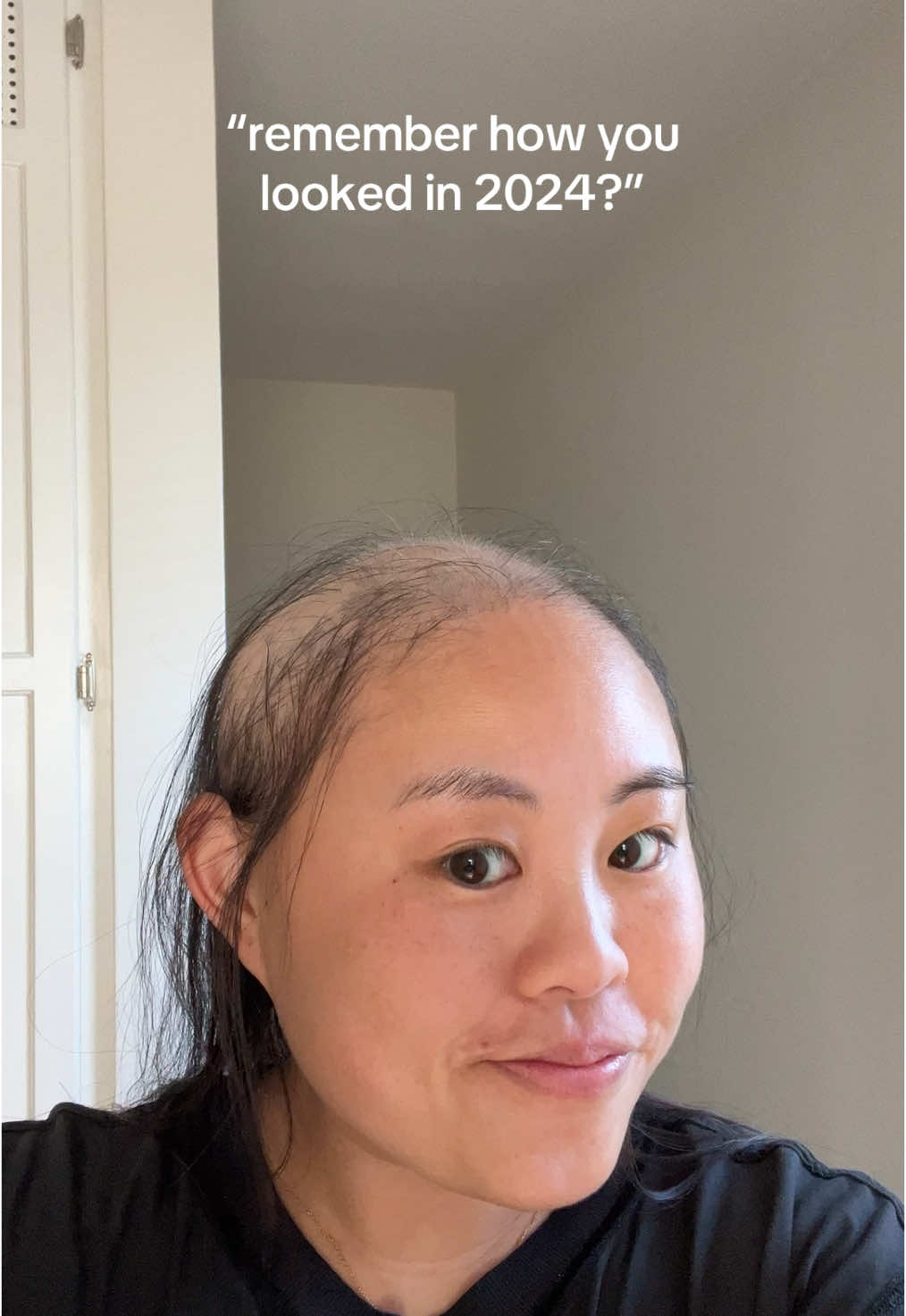 11 months later 🙏🏼  #creatorsearchinsights #alopecia #hairloss #hairgrowth #hairregrowth #hairjourney #hair #minoxidil #minoxidilresult #rogaine #alopeciaareata #telogeneffluvium #dreadshed 