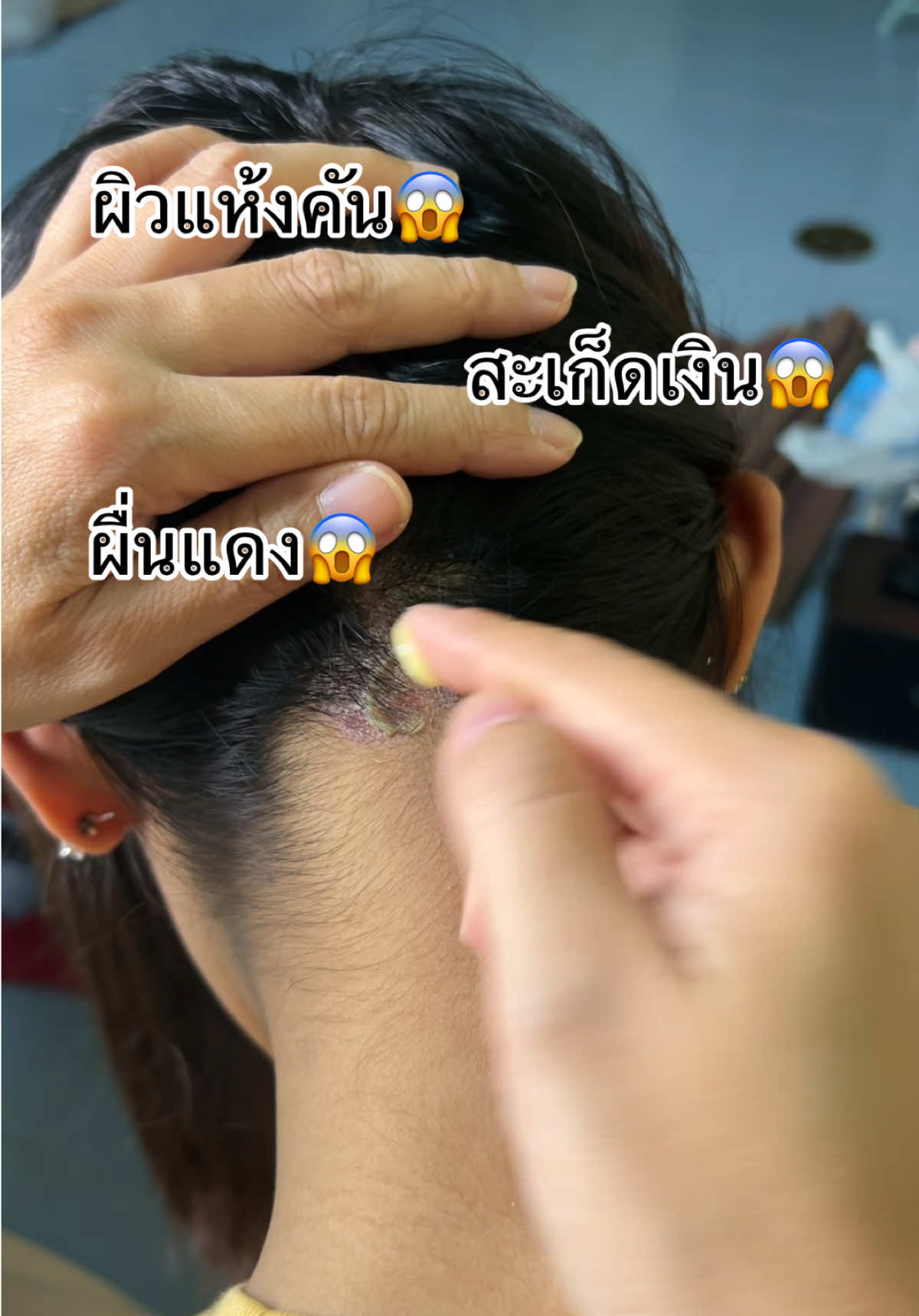 #ผิวแห้งคัน #สะเก็ดเงิน #ผื่นแดง ลองตัวนี้ #ค#ครีมทองพันชั่งค#ครีมแก้คันด#ดูแลตัวเองร#รีวิวของดีบอกต่อt#tiktokshopแ#แคร์ตัวเองกับอั้ม