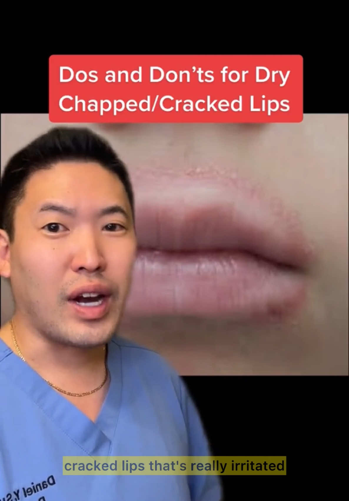 Relevant post for my many many patients and friends out there dealing with lip issues from the colder winter weather 🥶 👄 or with traveling (especially on the ✈️) #chappedlipsnomore #chappedlips #cheilitis #dryskincare #lipscrub #lips #dosanddonts #dontdoit #skincaremistakes #drsugaiskincare 