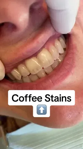 Coffee Stain removed! #coffeelover #dentist #smile #prophy #dental #whiteteeth 
