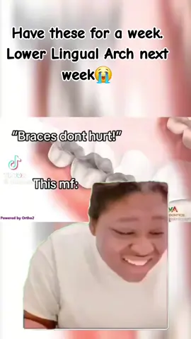 100% more pain than my adjustment i had on the top yesterday 😭#CapCut #braces #spacers #lowerlingualarch #bracesover40 #fyp #ouch 