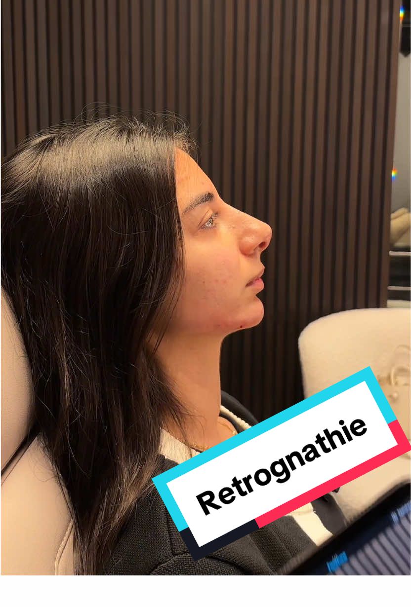 Was ist schöner: das Ergebnis oder ihre Reaktion? 🥹 (Educational purposes)  Wir können uns nicht satt sehen! 😍 Diese Ergebnisse sind tatsächlich mit Hyaluronsäure möglich: Kinn-, Jawline- und Nasenunterspritzung und die Retrognathie ist kaum mehr zu erkennen!  #retrognathia #jawlinefiller #chinfiller #nosefiller #facecontouring #transformation #GlowUp #happypatient #beauty #beautydoc #düsseldorf #berlin #konstanz 