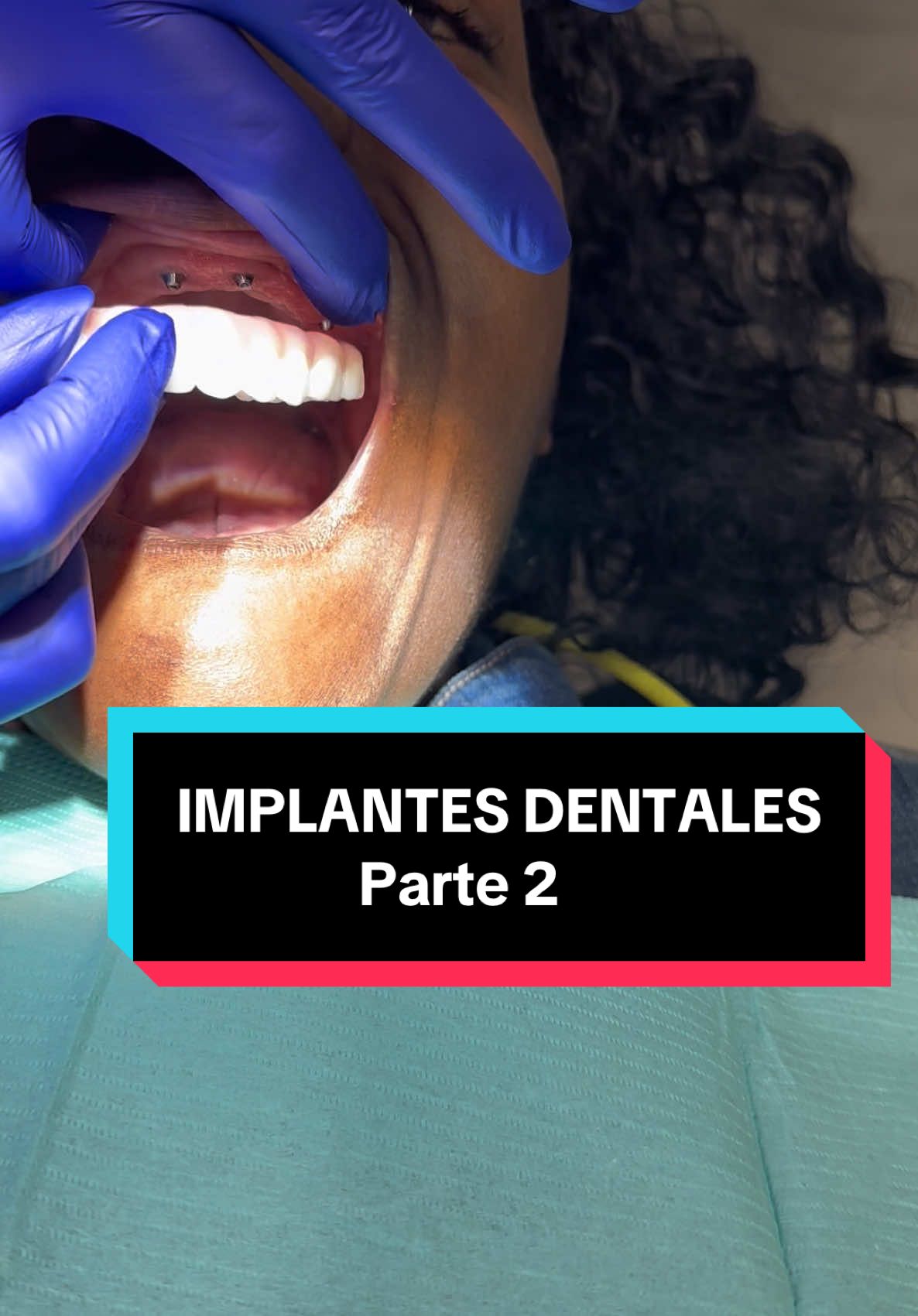 Los implantes dentales All-on-4 con dientes permanentes en un día son una solución avanzada para la rehabilitación dental completa. Aunque los pacientes reciben una prótesis fija el mismo día de la cirugía, el proceso de curación interna de los implantes dentro del hueso toma entre 3 a 6 meses. Durante este período, los implantes se integran con el hueso en un proceso llamado osteointegración, lo que les proporciona la estabilidad y resistencia necesarias para funcionar como dientes naturales. Durante los primeros meses, es importante seguir una dieta blanda para evitar ejercer demasiada presión sobre los implantes. Después de 6 meses, una vez completada la integración ósea, los pacientes pueden disfrutar de una dieta normal y comer de todo sin restricciones, recuperando la funcionalidad y estética de su sonrisa de manera segura y permanente #implantesdentales #cirugía #lasvegas #nuevayork #transformacion 