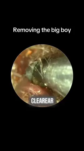 #CapCut #fyp #earwaxremoval #earwax #satisfying #cleaning #earwaxcleaning #tiktok #justforfun #justforyou 