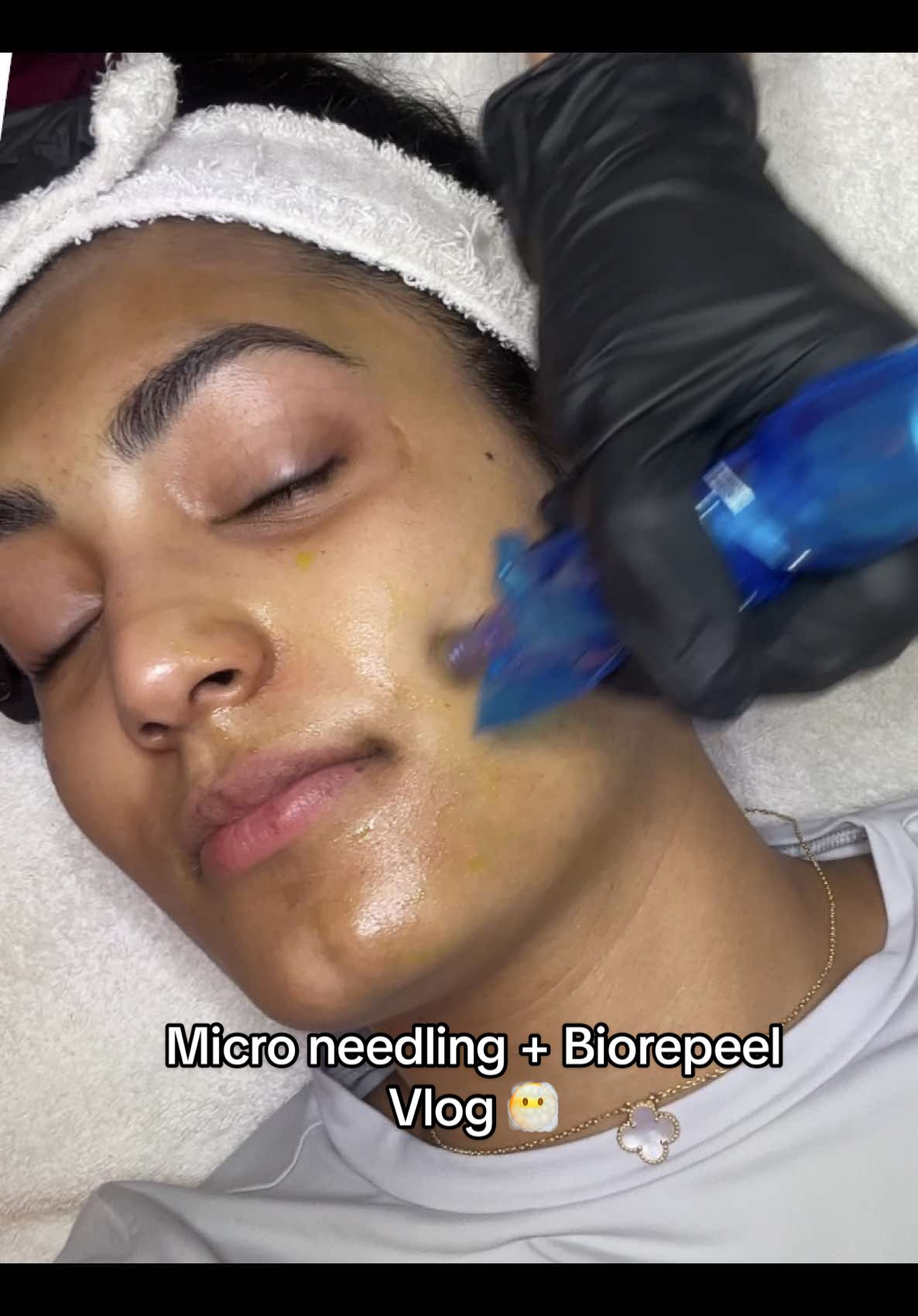 Micro needling vlog 🤍😶‍🌫️ #microneedling #microneedlingbeforeandafter #skintexture #hyperpigmentation #brownskingirl #biorepeel #biopeelingtreatment #brampton #skincare #fyp #glassskin 