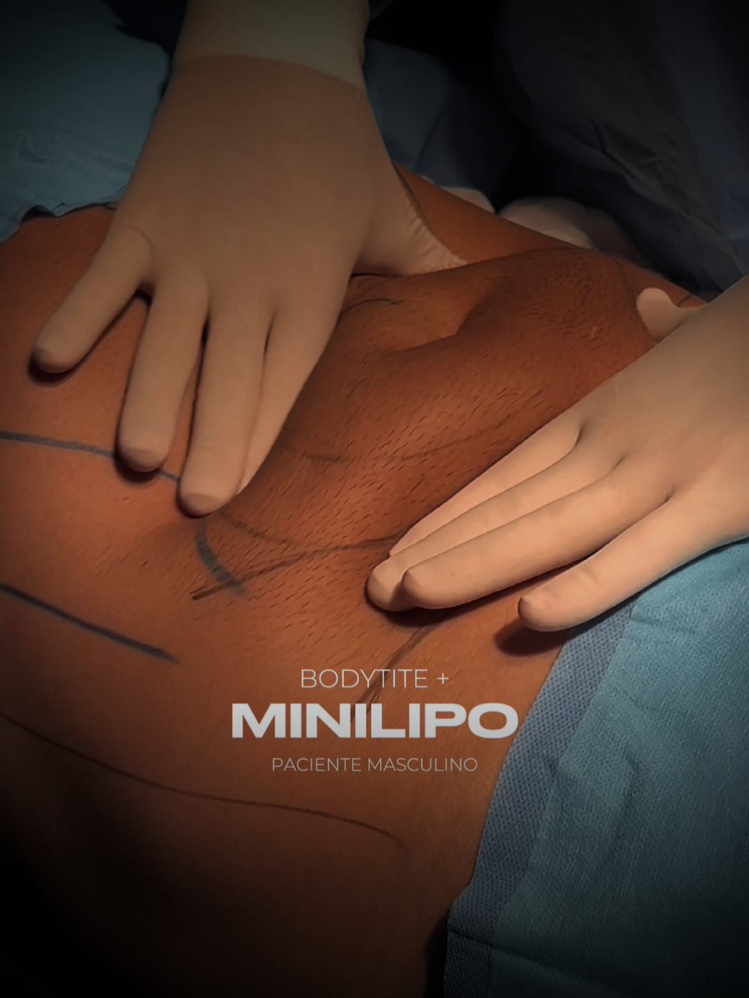 👉🏻 Diferente das lipoaspirações convencionais, esse procedimento permite que os pacientes voltem para suas atividades no dia seguinte. - O procedimento é ambulatorial e tem rápida recuperação. - Procedimento realizado em pequenas regiões. ⚜️ Siga @diariodomeubody e acompanhe a evolução de diversos casos! 🗓️ Agende sua avaliação. Clinica Harmonia CRM/RS 11664 RT Dra Mariana Losso CRM/RS 35458 RQE 33622 ✅Publicação de caráter acadêmico em conformidade com o despacho 143/2019 Conselho Federal de Medicina, art. 75, e autorizado via Termo de Consentimento Informado. ✅O resultado imediato pode sofrer alterações da cicatrização, inchaço, reabsorção das estruturas e pode não ser o mesmo após vários meses ou anos. Pode ter melhor definição ou perdê-la com o tempo dependendo das características de cada paciente. ✅Além disso, esse video NÃO serve como um modelo a ser escolhido para a sua cirurgia, pois o resultado sempre será de caráter individual e pessoal. Não garantimos resultados. #minilipo #gorduralocalizada #lipoaspiracao #cirurgiasegura #projetoverao #bodytite #morpheus #esteticacorporal #harmonia