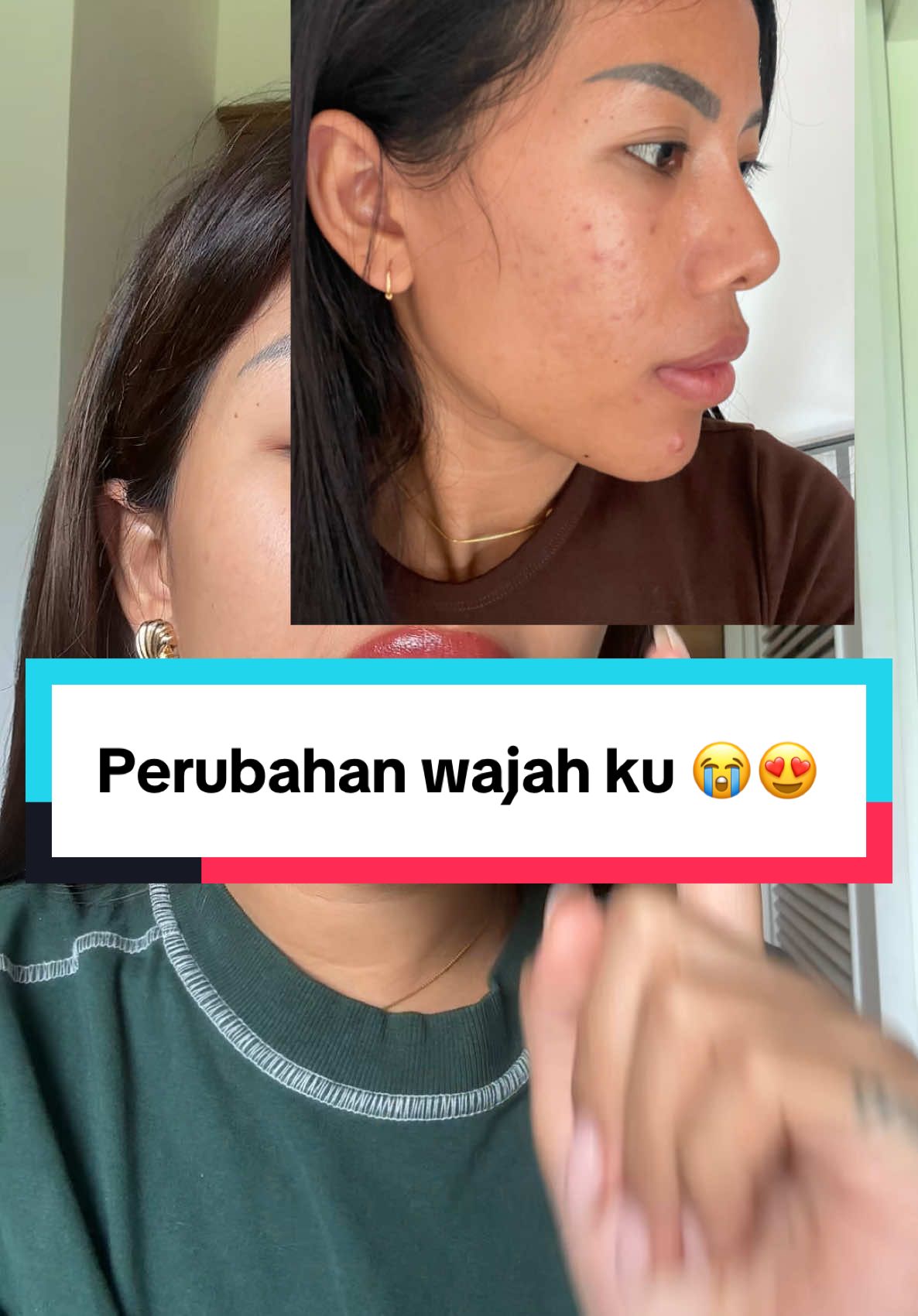 Banyak banget kan yang nanya aku pakai apa buat menghilangkan jerawat dan kulitku yang merah2 dan sensitif ini 😍  #fyp #fyppppppppppppppppppppppp #fypシ゚ #makeup #skincareroutine #skincaretips 