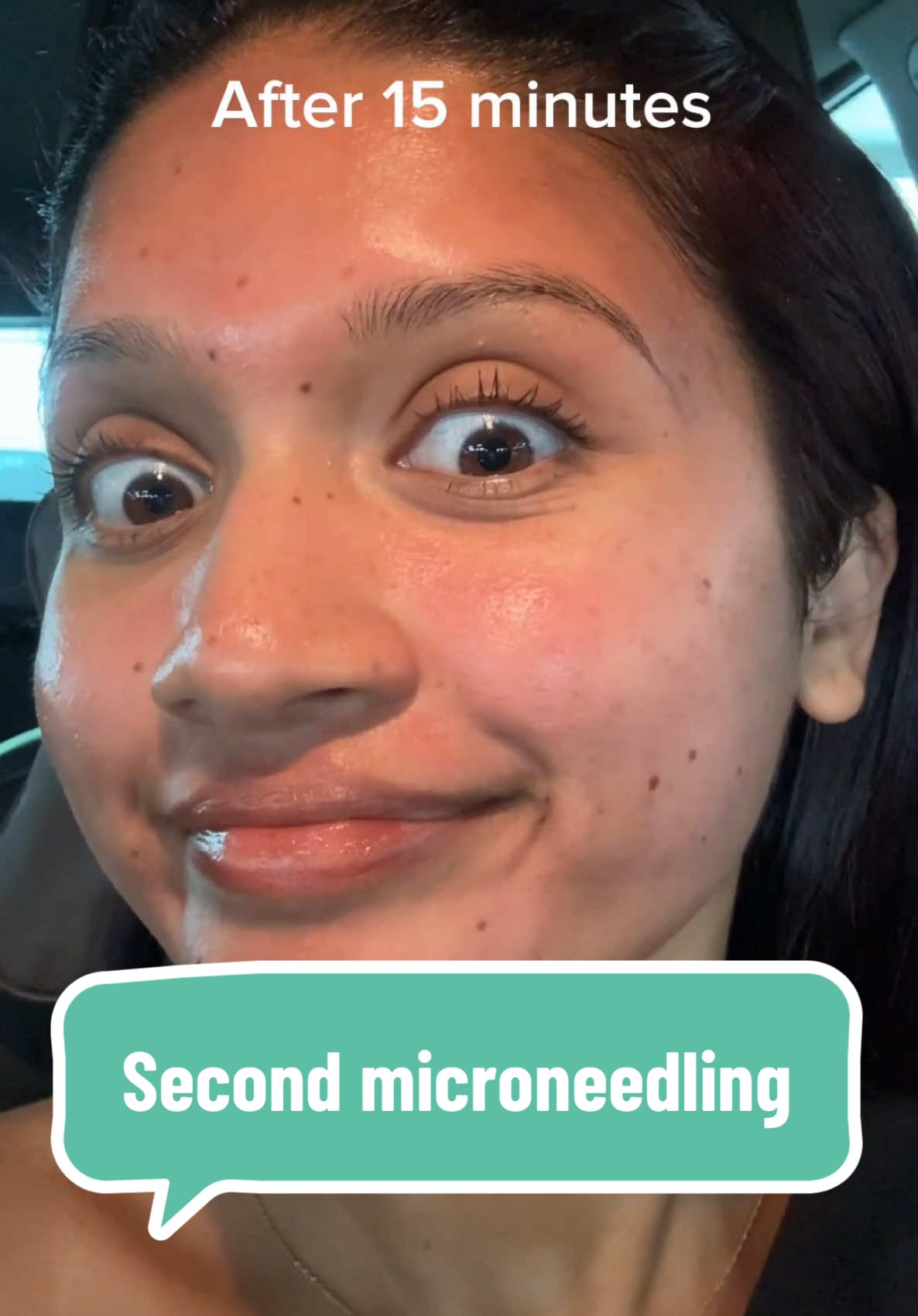 Second microneedling session complete! My face is on fire and stinging like crazy! 😏 #microneedling #microneedle #facemicroneedling #acneskin #acnescartreatment #acnescar 