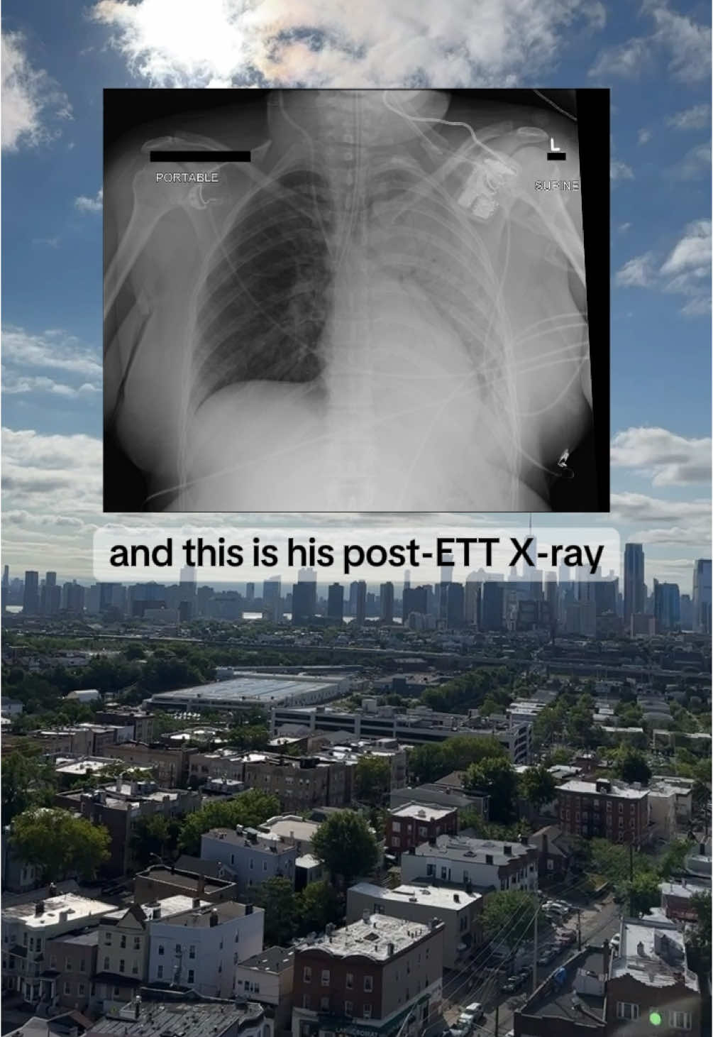 A. Panic  B. Remove ETT  C. Place left-sided chest tube D. Pull ETT back a few cm 🩻 What’s your diagnosis — what do you see on the X-ray that made you choose what you chose? #medicalquiz #clinicalmedicine #medstudent #doctorlife