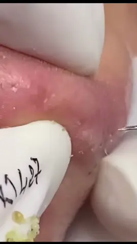Vale a pena assistir até o final 😍 #squeeze #viral_video #satisfyingvideo #limpeza #CleanTok #foryourepage #blackhead 