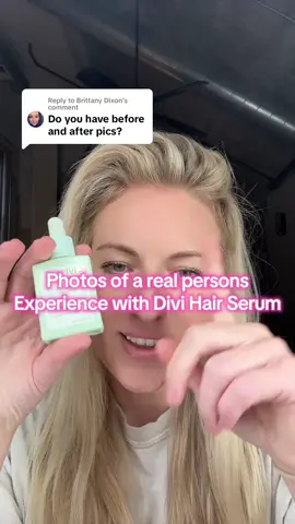 Replying to @Brittany Dixon #greenscreen Here you go!!!! I took photos of my hair growth progress because i originally got @Divi Scalp & Hair Health to “de-influence” it. Then I fell in love with their hair thinning serum and have become such a big advocate of their stuff! I ONLY share things I truly use and Love!  @Dani Austin  #divi #hairgrowth #hairgrowthtips #divihairserum #hairthinning #balding #postpartumhairloss 