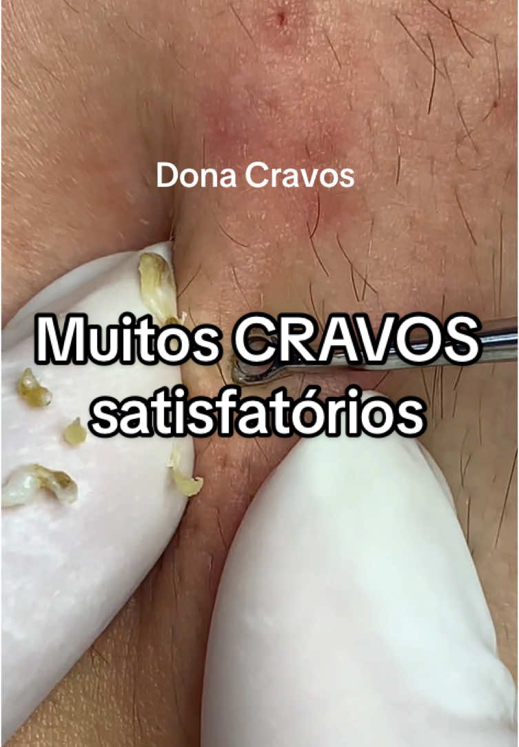 É disso que vocês gostam, né? Extrator Dona Cravos em ação para remover muuuuuitos cravos robustos e satisfatórios!  #extraçõesdecravos #limpezadepele #pimples #estranhamentesatisfatório 