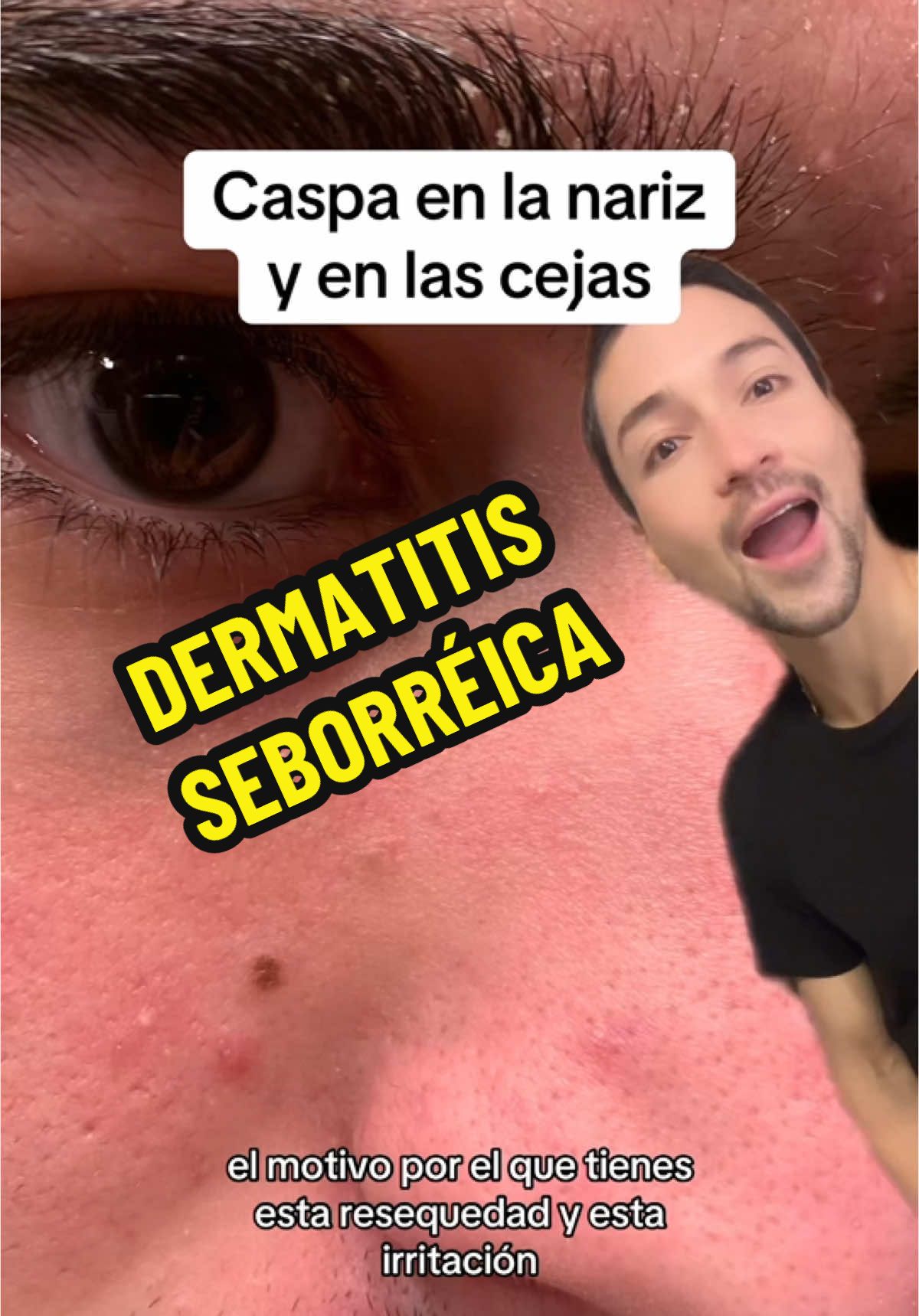 Tips para la dermatitis seborréica #dermatitisseborreica #malassezia #pityrosporumfolliculitis #pielgrasa #skincare #skincaretips #pielseca #ketoconazol #azelaico 