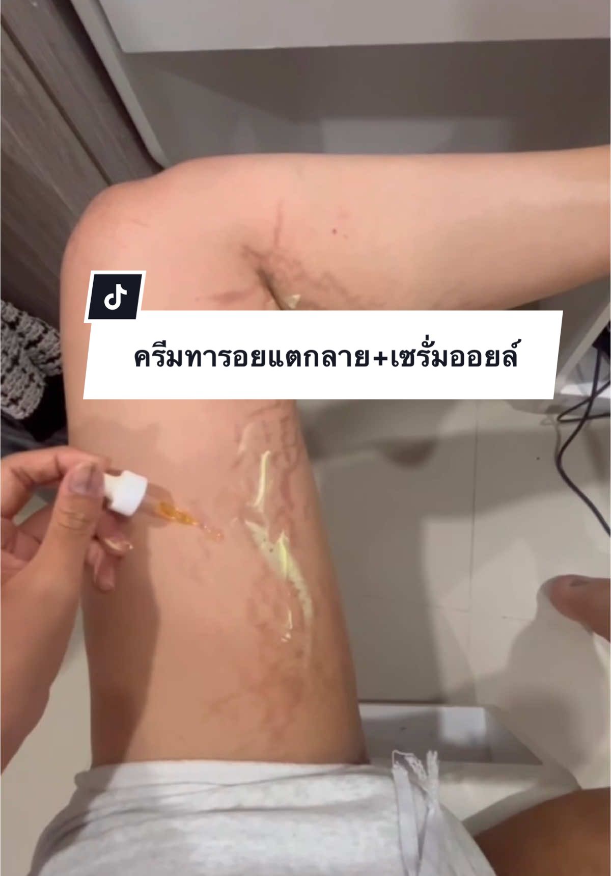 ใช้ดีมากๆ สารสกัดเข้มข้น ลดรอยแตกลายอย่างดี หนักกว่านี้ก็หายมาแล้ว ‼️#รอยแตกลาย #นิวไวท์ #ครีมทารอยแตกลาย 