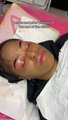 I love starting new bio peel journeys with my clients! Although my client didn’t have major skin concerns she really wanted to fade away the marks as nothing was working!  Her skin has improved! And we are now maintaining the results with recommended home care and regular professional facials with me.  Before and after pictures shared at the end! The results were achieved from one peel but honestly results vary from person to person ✨ PSA: The bio peel isn’t a quick skin fix. You will still need to change your lifestyle if you want to achieve healthy glowing skin! #biopeel #biopeelinguk #biopeelingtreatment #biopeellondon #chemicalpeel #skinjourney #skincare #hyperpigmentation #hyperpigmentationtreatment #scarringtreatment #london #bermondsey #SkinRenewal #HyperpigmentationSolution #GlowingSkin #BeautyTreatment #SkinTransformation #SkinHealing #AcneScarRemoval #SkinDetox 