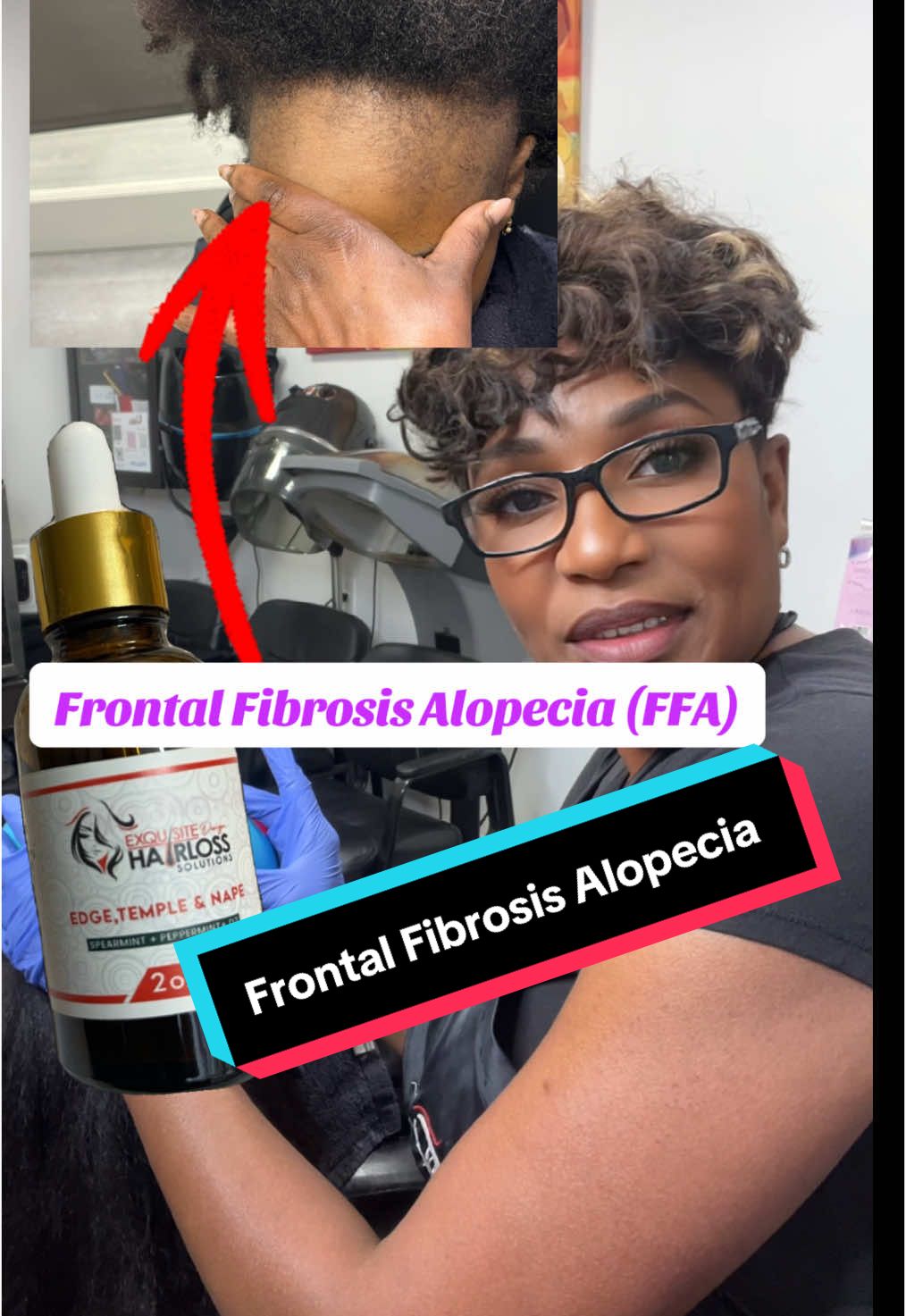 Frontal Fibrosis Alopecia suggestions are commonly connected to hormones as well as Stress and possibly environmental factors #hair #haircare #healthyhair #hairloss #alopecia #blackhair #beauty #blacktictok #women #men #hairtok #broward #florida #bahamiantiktok🇧🇸 #hairgrowth #toctokhair #hairtoc #christian #FFA #thinninghair  #frontalfibrosingalopecia 