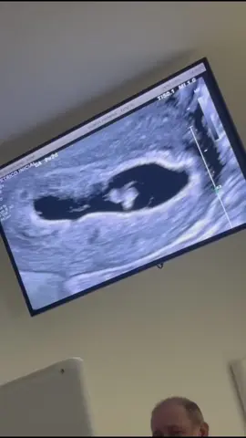 me doeu muito quando o médico disse “não tem batimentos cardíaco” só queria que fosse mentira, tava tão feliz quando descobri que você viria e no fim tudo acabou 💔🖤 #maedeanjo #aborto #tristeza #fyp 