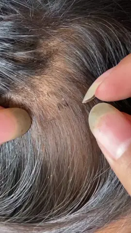 #lice #liceremoval #tick #omg #fyp 