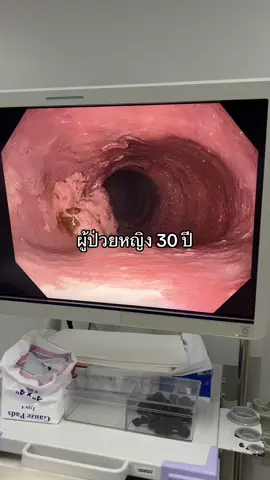 หลอดอาหารบีบตัวไม่ดี กรดไหลย้อน #หลอดอาหารบีบตัวไม่ดี #กรดไหลย้อน #achalasia #หมออุดมรัช  #หมอโตโต้  #พญาไทนวมินทร์ #กรดไหลย้อนเรื้อรัง 