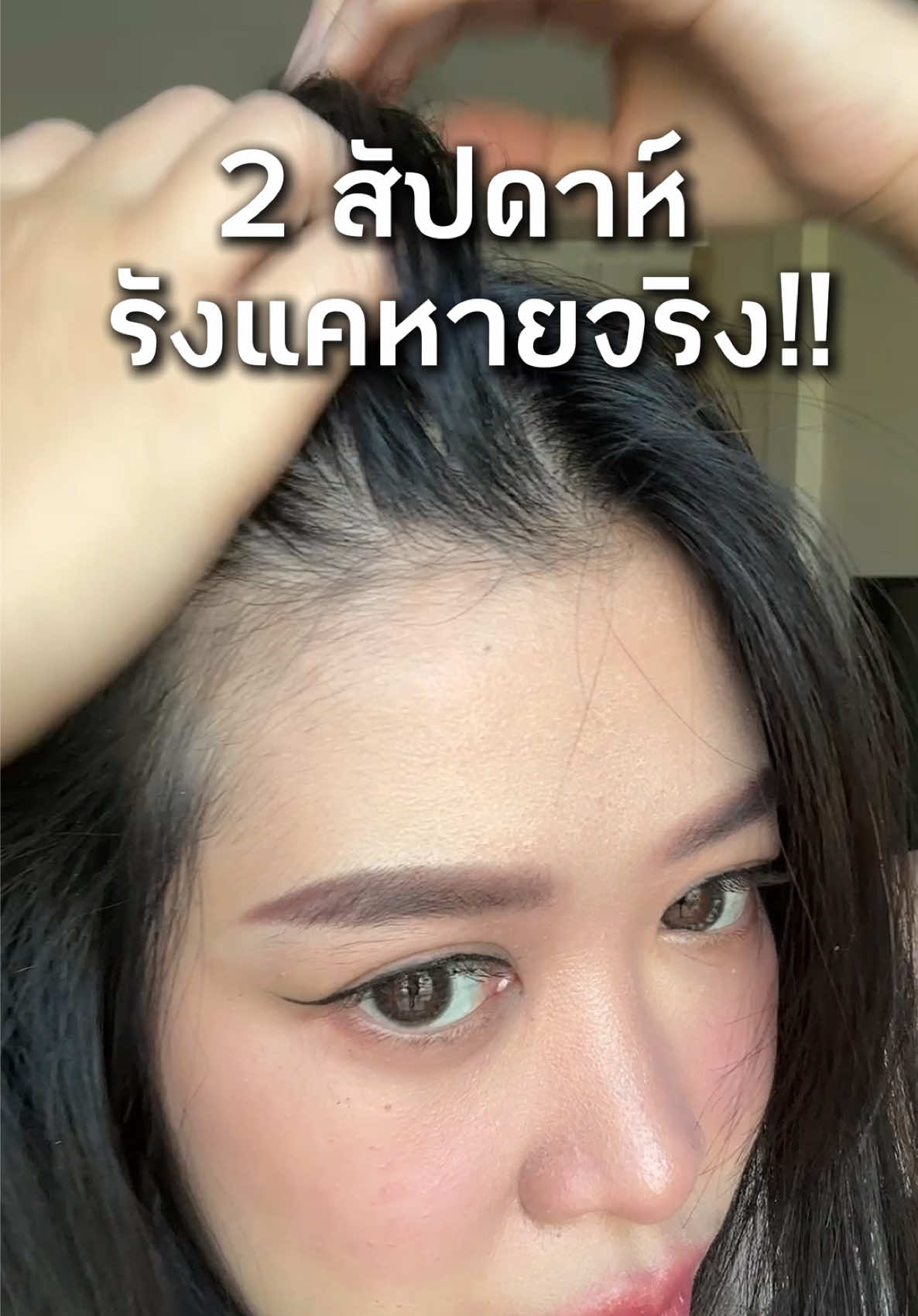 หิมะรังแคตกแล้วจ้าาา แต่เราแก้ปัญหารังแค ด้วย Selsunblue ขจัดรังแคได้ใน 2 สัปดาห์เริ่ดๆๆ ใช้ดีมากๆ ใช้ตัวไหนแล้วไม่หายแนะนำให้ลองตัวนี้เล้ยย #selsunblue #แชมพูขจัดรังแค #แชมพูกำจัดรังแค #รังแค #howto #สระผม #ยาสระผม #เป็นรังแคนึกถึงเซลซั่นบลู  