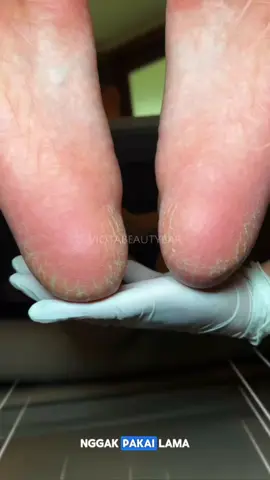 Kaki pecah-pecah bikin nggak nyaman dan kurang percaya diri? 😣✨  Saatnya memberikan perawatan terbaik dengan Pedicure Callus Removal di Viota Beauty Bar! Treatment yang berfungsi mengangkat sel kulit mati, melembutkan, dan membuat kakimu kembali halus.  Yuk, sayangi kakimu dan rasakan perbedaannya!  📍 Viota Beauty Bar on maps 📞 whatsapp 081233577755  #ViotaBeautyBar #PedicureCallusRemoval #KakiSehatDanHalus #PerawatanKakiTerbaik 