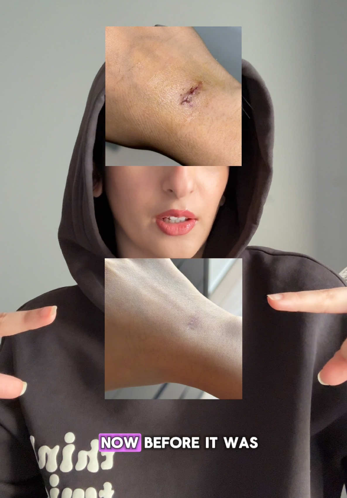 Scar treatment that works wonders!!💖🫶🏻 Tag @ISDIN below🫶🏻 #scartreatment #scar #scartissue #scarremedy #scars #keloid #keloidtreatment #isdin   