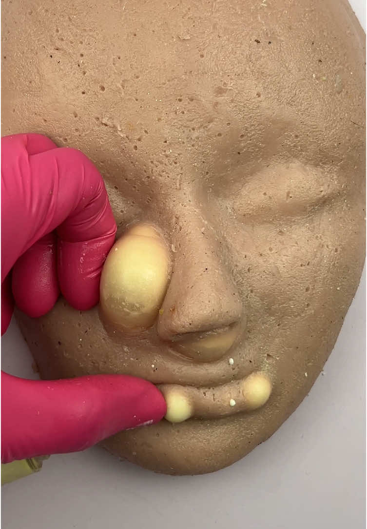 New model - testing acne injection on silicone face model . Satisfying??? #artificialskin #siliconemodel #education #oddlysatisfying #pimplepopping #relaxingcontent #skincaretips