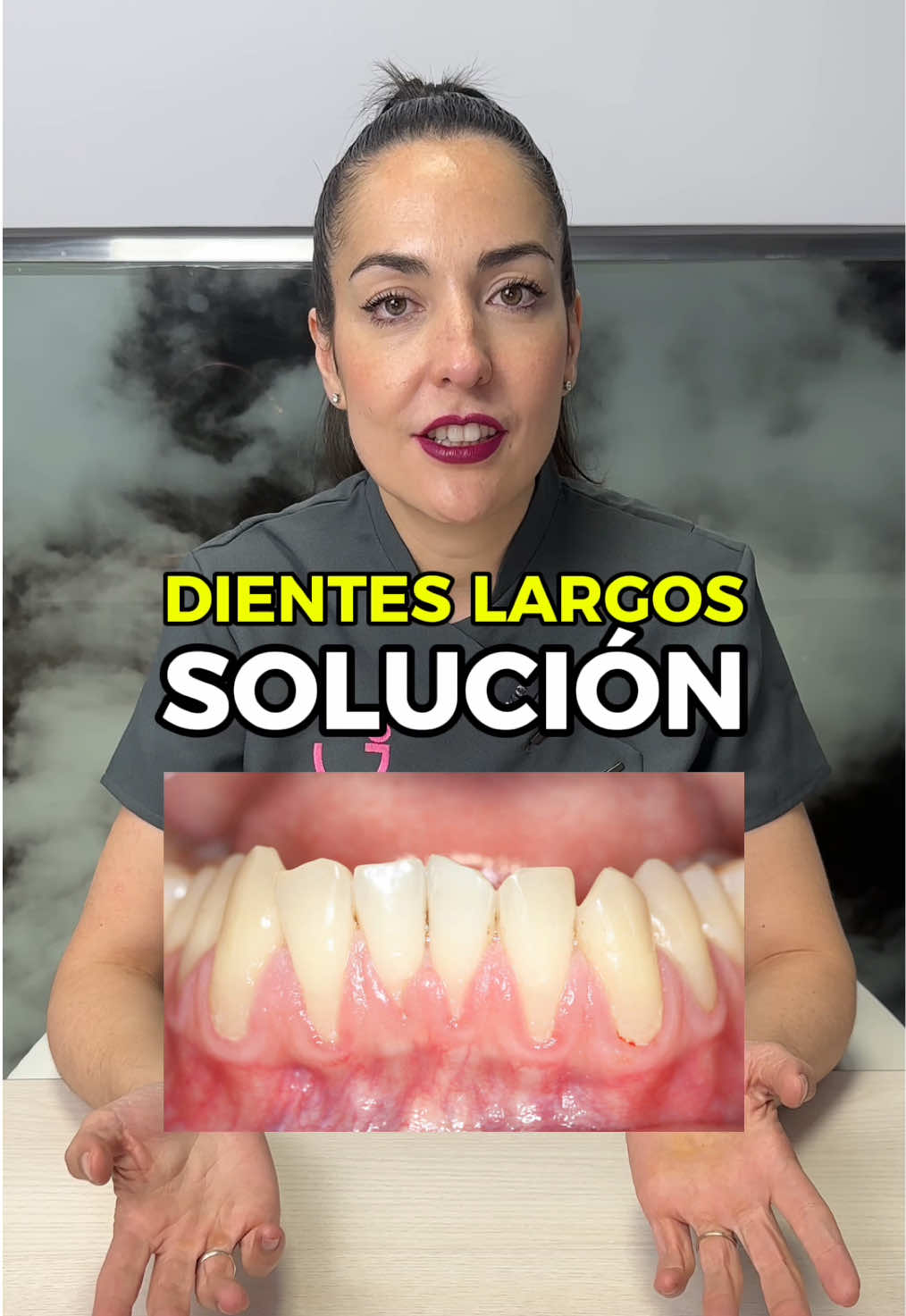 ¿Sientes que tus dientes se ven más largos? Podría ser retracción de encías, ¡pero hay solución!  #EncíasSaludables #RetracciónGingival #SonrisaPerfecta #CuidadoDental #SaludBucal #DentistaEspecialista #EncíasFuertes #RecesiónGingival #TratamientoDental #SaludOral #CuidadoDeEncías #EstéticaDental #Periodoncia #Ortodoncia #HigieneBucal #Dentista #ClínicaDental #DientesSanos #PrevenciónDental #SonrisaSaludable #RejuvenecimientoDental #EncíasRosadas #Odontología #BlanqueamientoDental #LimpiezaDental #DentistaDeConfianza #TipsDentales #consultadental 