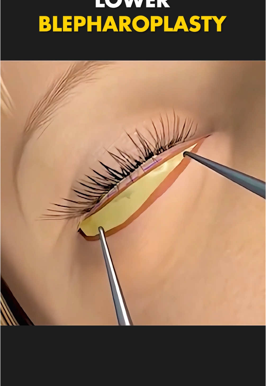 Transcutaneous Lower Blepharoplasty Procedure (3D Animation) #blepharoplasty #transcutaneouslowerblepharoplasty #eyebags #eyebagsurgery #lowerblepharoplsty #blepharoplastyexplained #medical3danimation #3dmedicalanimation 