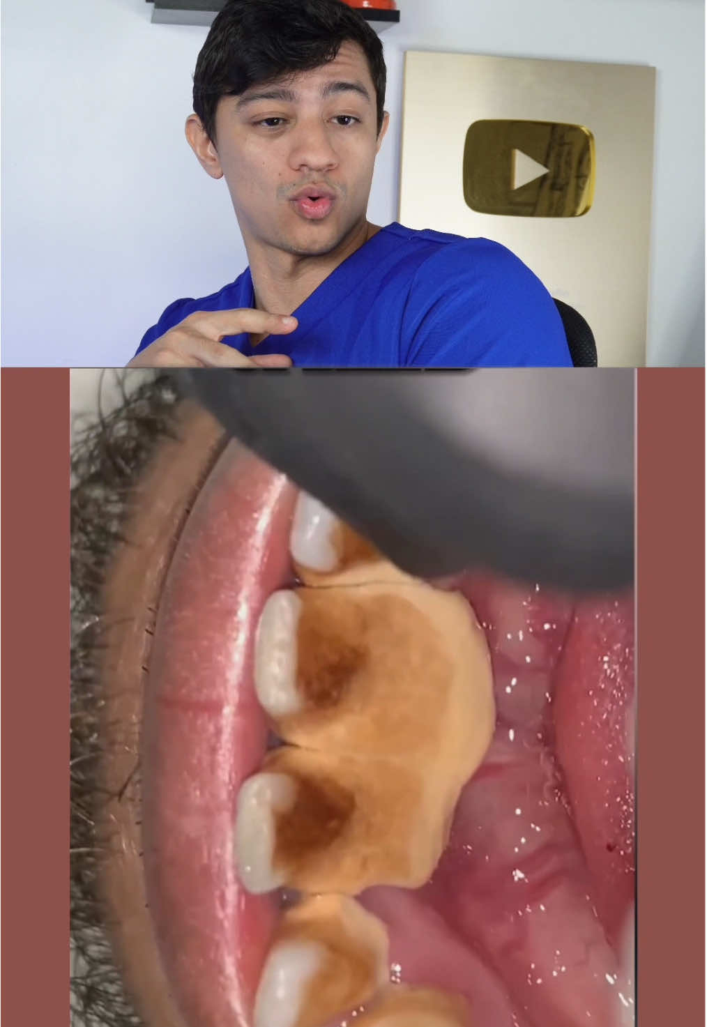 Anos sem escovar os dentes😲 #ortodontia #dentista 