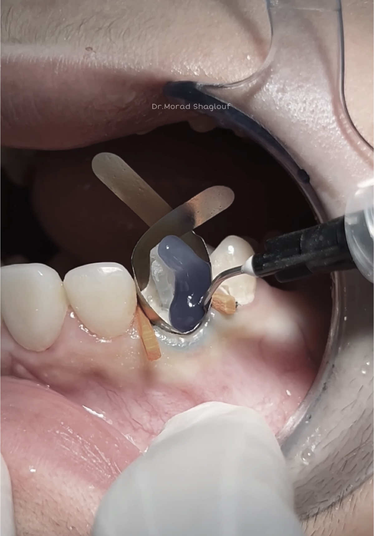 Composite restoration and fiber post after root canal treatment #dentist #dental #dentistry 