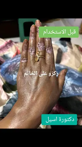 #البرونزية #خلطات_طبيعية #خلطات_تبييض #خلطات_جسم #خلطات_تفتيح_اليدين #الشعب_الصيني_ماله_حل😂😂 #للطلب_واتساب0904026116 #السودان #السعودية #مصر🇪🇬 #الامارات_العربية_المتحده🇦🇪 