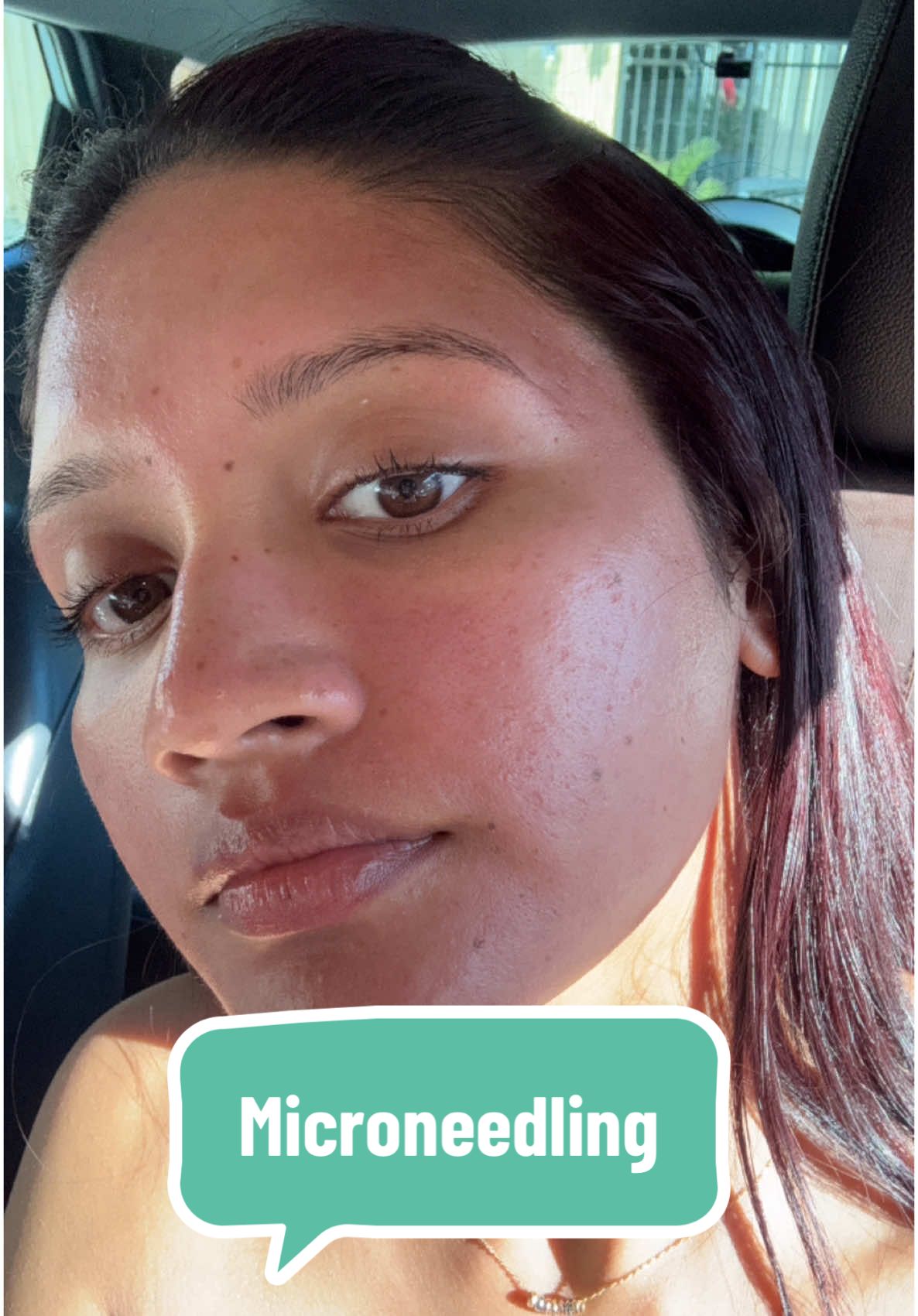 Replying to @bdboyz605 Microneedling for acne scars—worth it? 🤔 I’ve done two sessions so far, one more to go! It’s supposed to boost collagen and improve skin texture, but I haven’t seen drastic changes yet. Maybe it takes more time? Have you tried microneedling? Let’s chat in the comments! #microneedling #skincarejourney #acnescartreatment #microneedlingface #acnescar #acneskin 