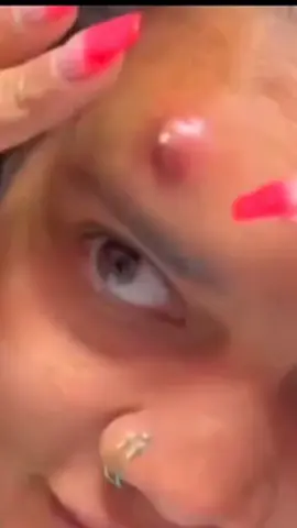 #creatorsearchinsights #pimples #pimple #pimplepopper 