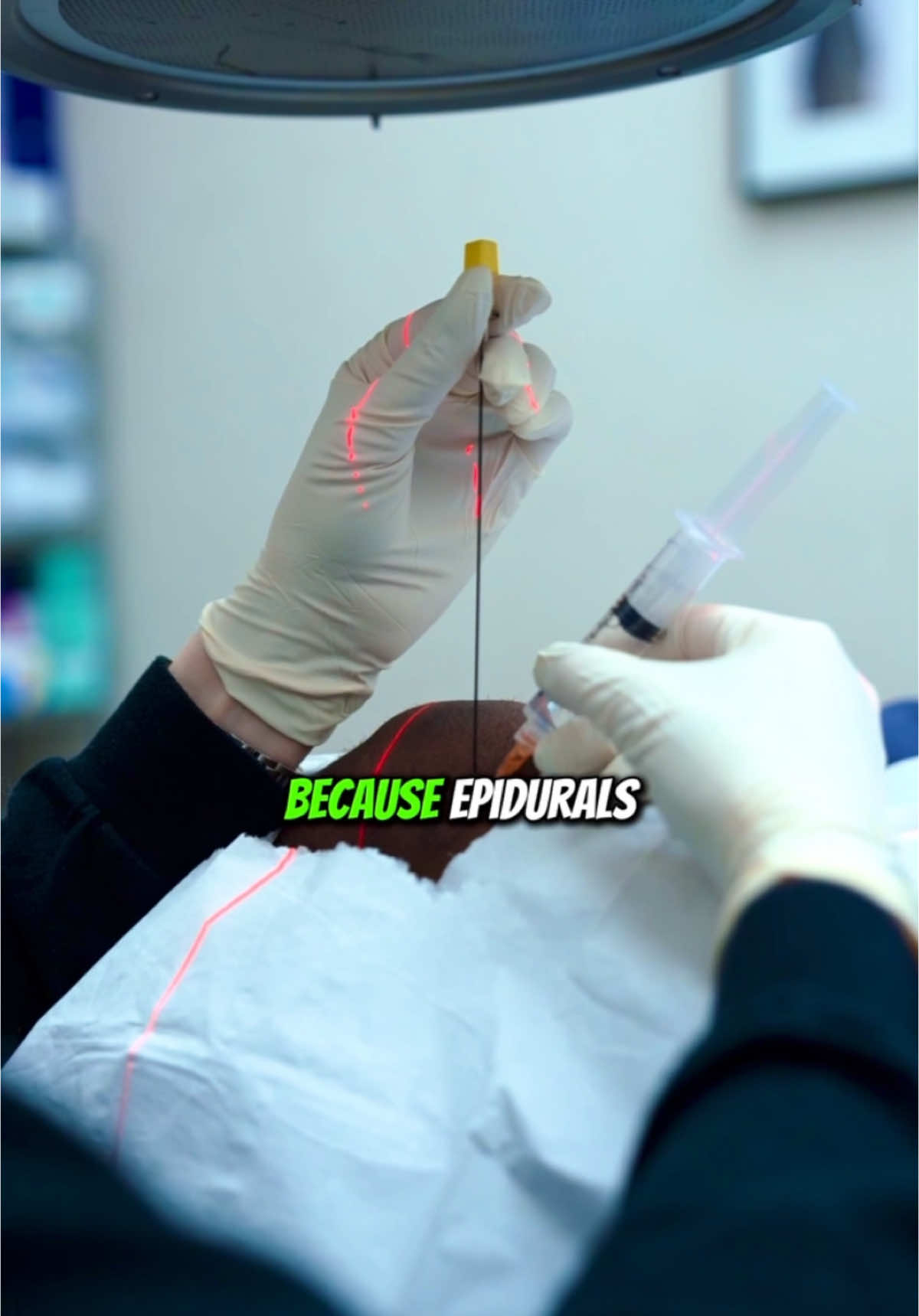 How to alleviate back pain? Treating spinal stenosis can be challenging because the real issue is narrowed spaces in the spine, which put pressure on nerves. While surgery may be needed to physically open up those spaces, epidural steroid injections and nerve blocks offer a much simpler option for pain relief. 💉✨  These treatments reduce inflammation and block pain signals, helping you move more comfortably without the need for surgery. 🏃‍♂️  #backpain #kneepain #painmanagement 