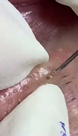 #squeeze #satisfyingvideo #viral_video #limpeza #CleanTok #foryourepage #blackhead 