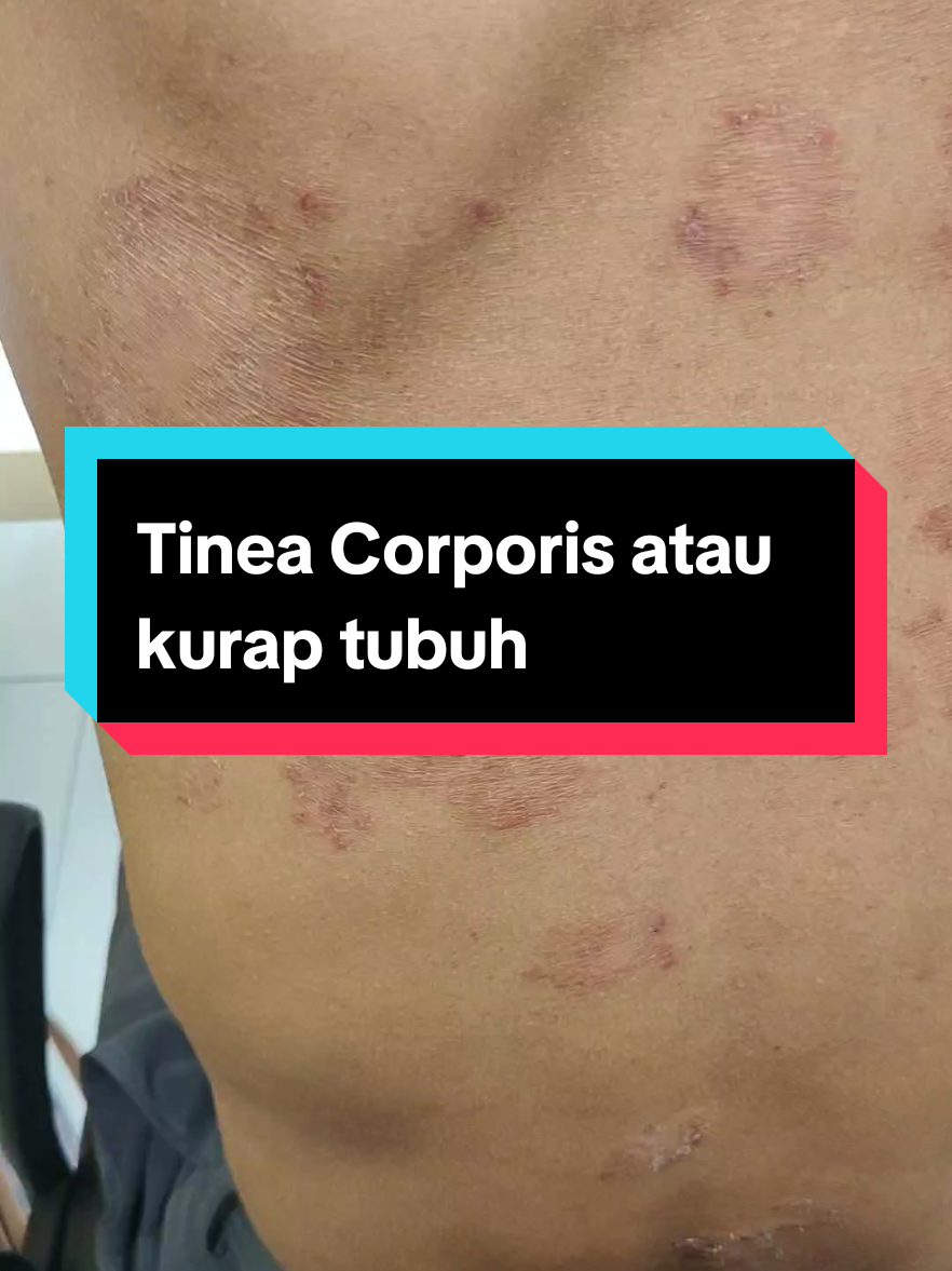 Tinea corporis atau kurap tubuh disebabkan oleh infeksi jamur konsul ke dokter spesialis kulit#foryoupage#fypシ゚viral#foryou#fypシ゚#kurap#kulit#tineacorporis#fyp 