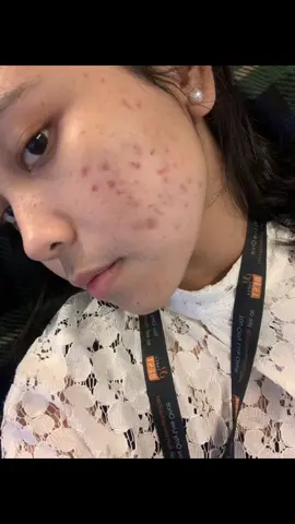 memang gak instant, tapi hasilnya benerbener 🥹🥹🥹🥹 #bioderma #larocheposay #cicaplastbaumeb5 