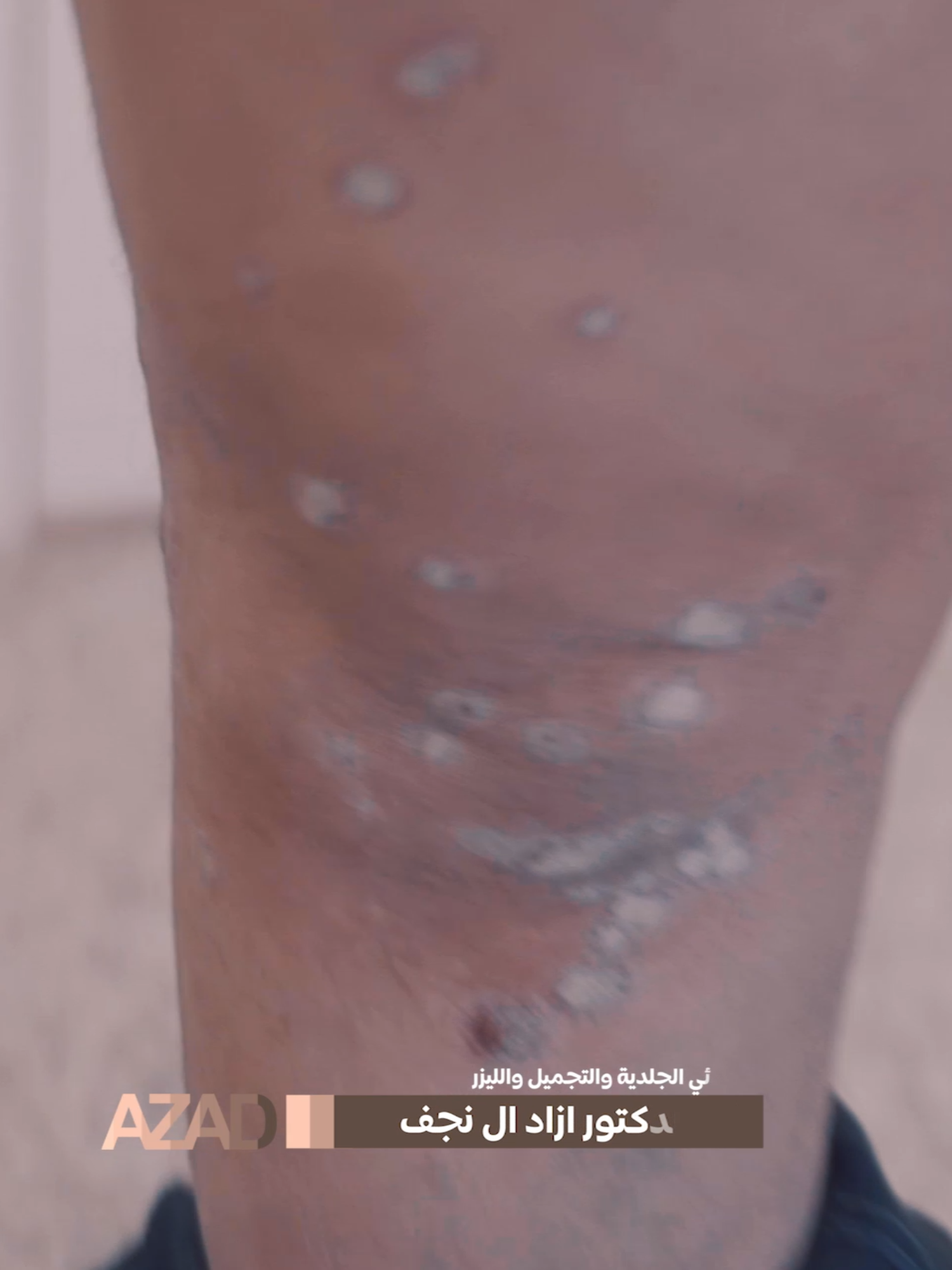 من حالات الصدفية المتقدمة .. تم العلاج خلال مدة قصيرة بفضل الله #صدفية #صدفيه #بهاق #فطريات #ثعلبة #صدفية_الشعر #اكسبلور #الدكتور_ازاد_احمد_ال_نجف