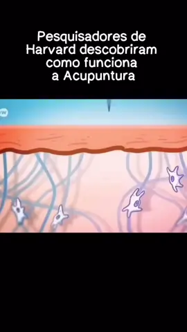 Como funciona a ação da Acupuntura? Os principais mecanismos de ação da acupuntura consistem em microlesão, aumento do fluxo sanguíneo local, cicatrização facilitada e analgesia por estímulo de opióides endógenos e estimulação nervosa periférica. Essa técnica é muito conhecida pelo tratamento de dor, porém ela vai muito além! Essa técnica milenar é eficaz em diversos tratamentos de saúde! Fonte: https://pubmed.ncbi.nlm.nih.gov/15550321/ #saúde #acupuntura #mecanismo #técnica #tratamento #medicinachinesa 