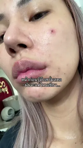 มันโคตรดีซื้อเถอะ!!! ##เซรั่มสตอ##ลดรอย##yerpallthailand##จขบเซรั่มสตอ
