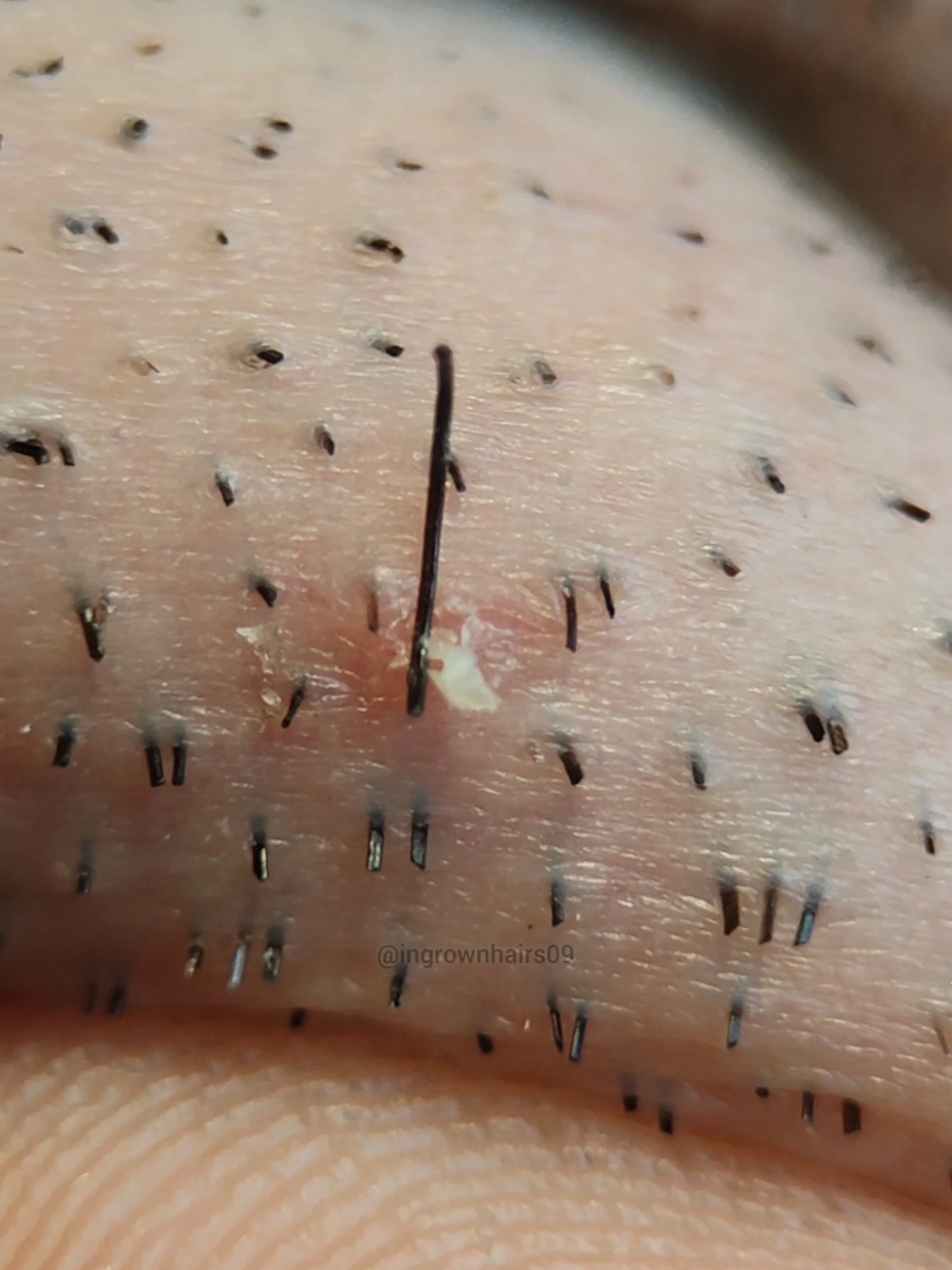 some of my satisfying ingrown hair extractions!😊 #extractions #ingrownhair #hairpulling #satisfyingvideo #ingrownhairremoval #asmr #relax #tweezers 