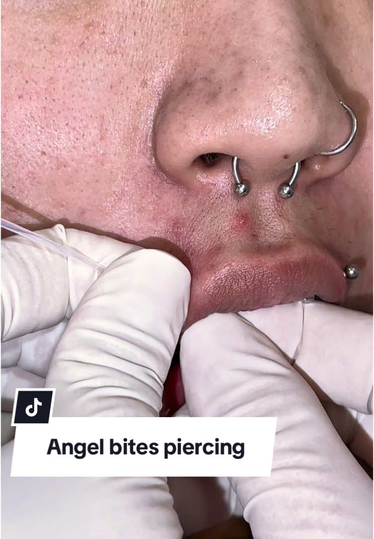 Angel Bites piercing #angelbitespiercing #piercing #piercings #piercinglovers #piercingstudio #piercingvideo #piercingvideos #piercingsoftiktok #piercinglovinhos #piercingjewelry #vairal #fypシ゚viral #allfake⚠️ 