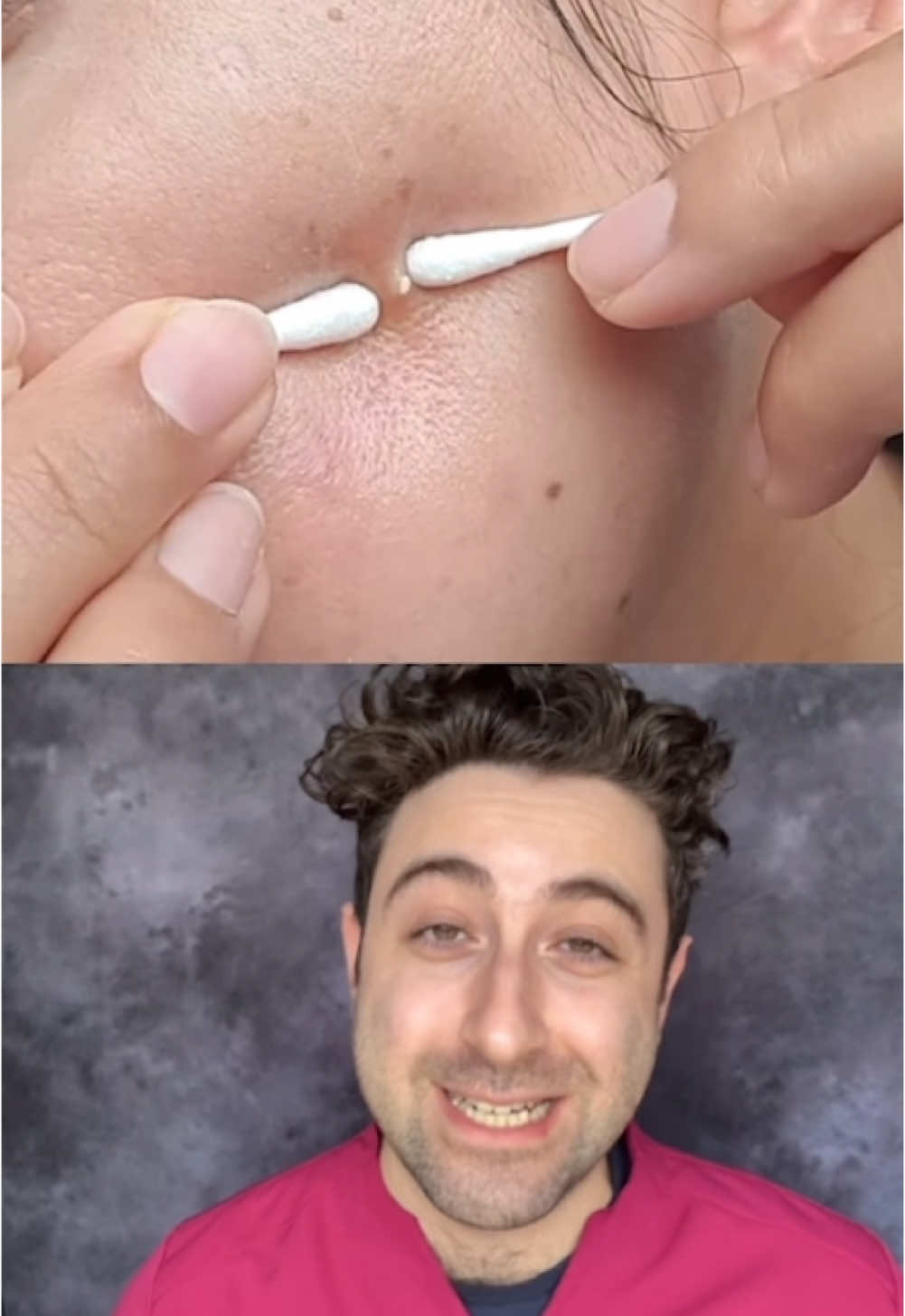 #pimplepatch #pimpleremoval #pimplepopper #pimple #acnewarrior #blackhead #cyst #acne #skincare #pimplepopping 