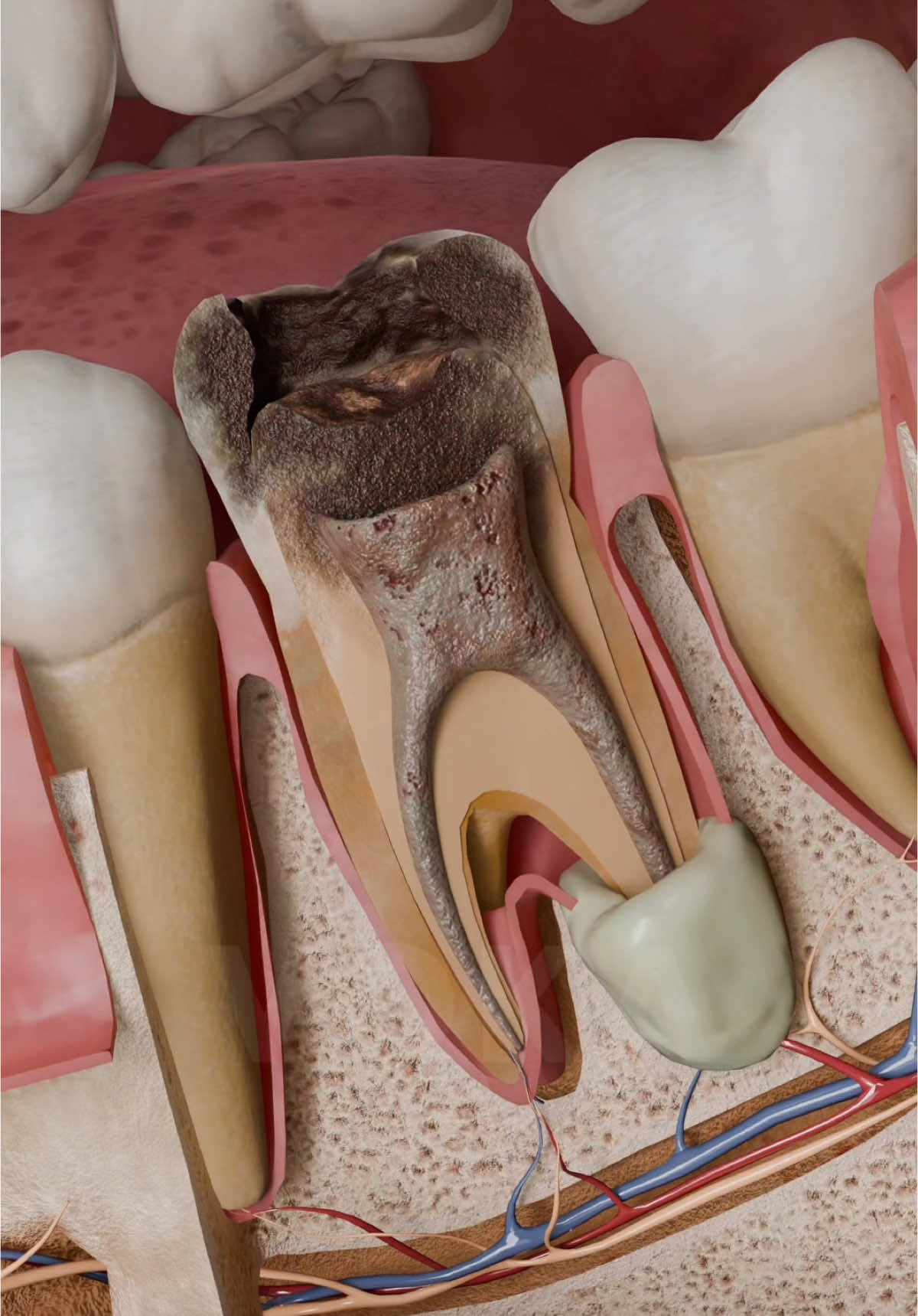 The hidden danger in your tooth: acute apical abscess explained in 3D     🔍 Want to learn more about tooth anatomy and dental infections? Check out VOKA 3D Anatomy & Pathology!   #dentalhealth #apicalabscess #oralhealth #anatomy #anatomy3d #3danatomy #medstudents #medicalstudents #medicaltsudent #digitallearning #humanbody